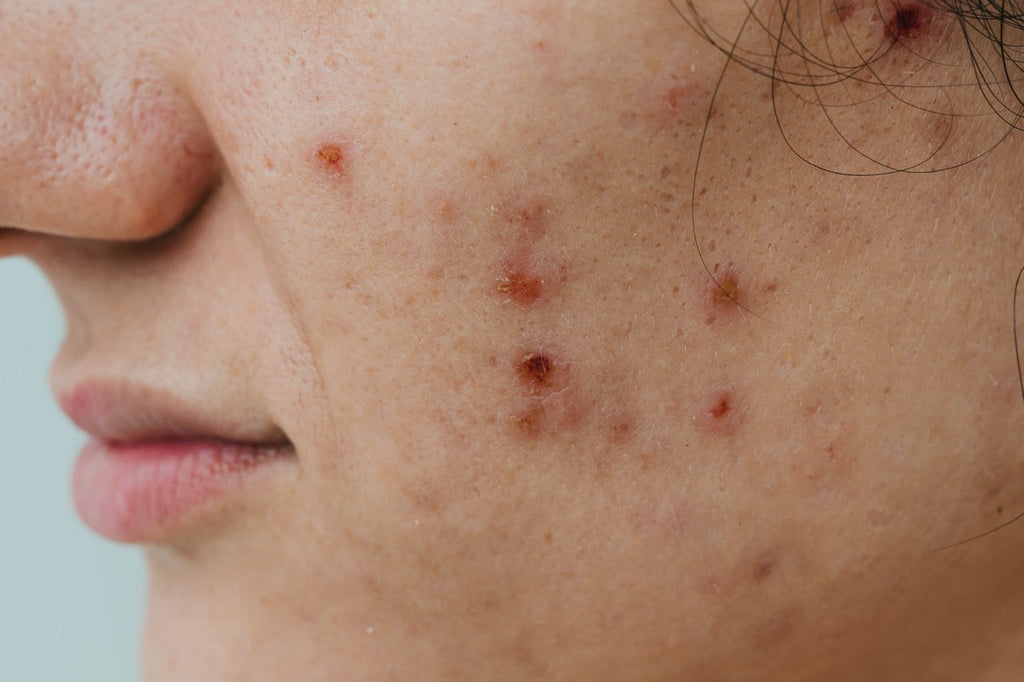 Tratamento para marcas de acne: um guia completo