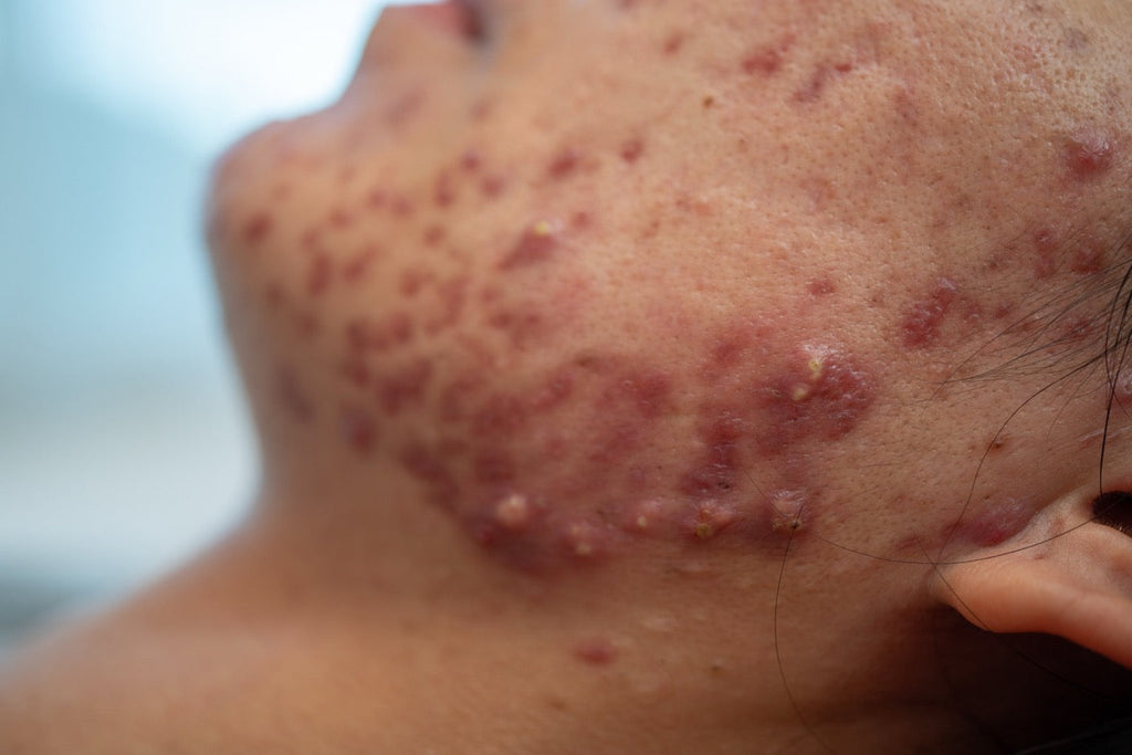 O guia completo sobre cleanser gel com pH balanceado para pele acneica