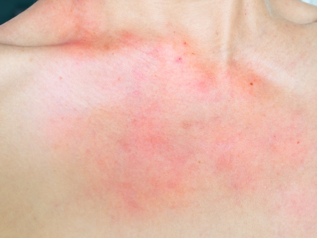 Alergia na pele do rosto: guia para acalmar e prevenir