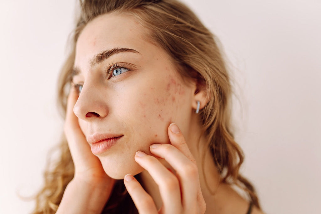 Como tratar cicatrizes de acne e renovar sua pele