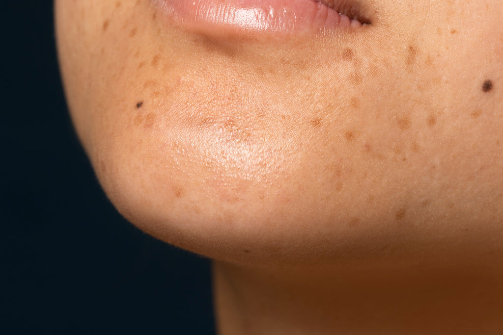 O que é melasma e por que ele afeta tanto as brasileiras