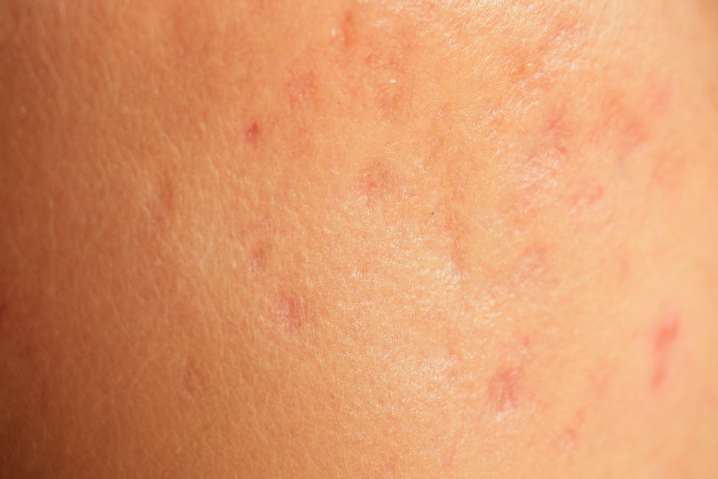 Como tirar manchas de acne: um guia para uniformizar o tom da pele